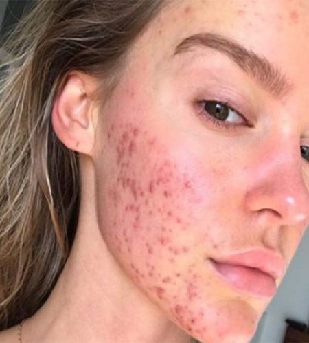 https://beautycura.com/wp-content/uploads/2020/05/acne-450x499.jpg