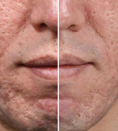 https://beautycura.com/wp-content/uploads/2020/05/microneedling_acne_behandelingen_rotterdam-450x499.jpg