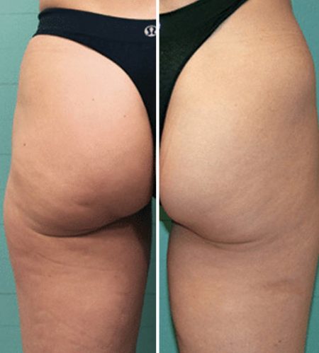 https://beautycura.com/wp-content/uploads/2020/05/microneedling_cellulitis_behandelingen_rotterdam-450x499.jpg