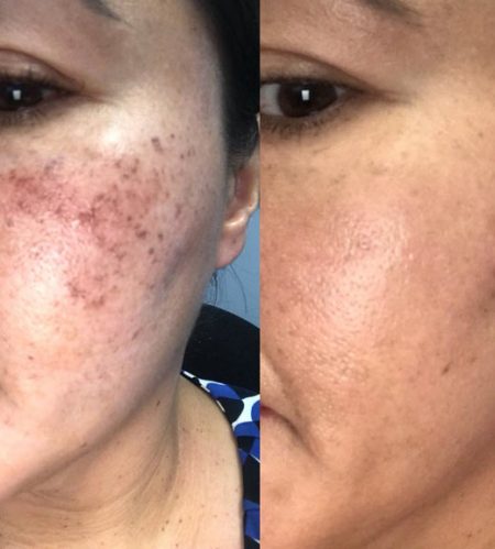 https://beautycura.com/wp-content/uploads/2020/05/microneedling_litteken_behandelingen_rotterdam-450x499.jpg