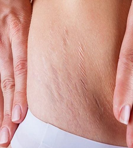https://beautycura.com/wp-content/uploads/2020/05/microneedling_striae_behandelingen_rotterdam-450x499.jpg